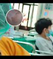 308准分子紫外光治疗仪怎么买最好