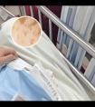 308准分子光治疗范围