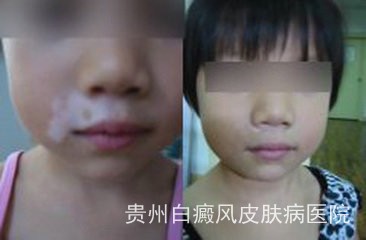 面部白癜风的治疗方法有哪些 面部白癜风的治疗方法有哪些