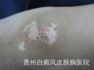 遵义白癜风医院哪家治疗好 遵义白癜风医院哪家治疗好
