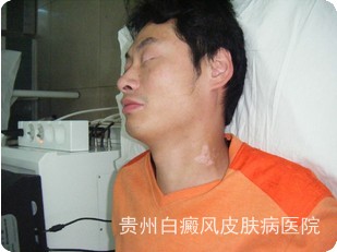 青少年患上白癜风的因素有哪些 青少年患上白癜风的因素有哪些
