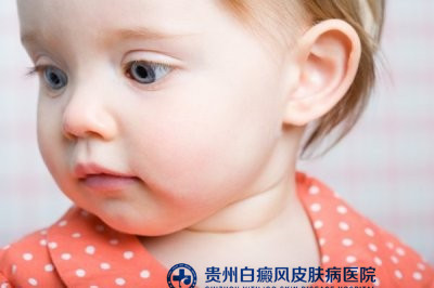 安顺有治疗白癜风的吗 安顺有治疗白癜风的吗