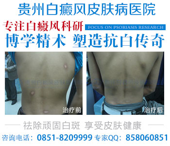 陪你认识白癜风症状