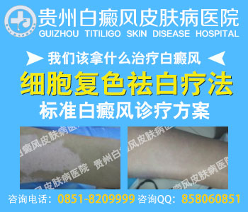 简介白癜风的自我诊断方法