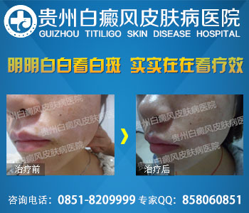 白癜风患者不能吃什么