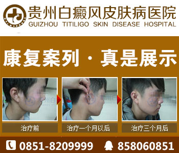 白癜风的主导因素有哪些