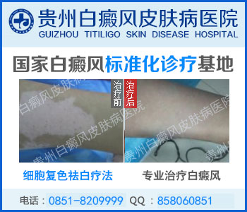 白癜风常见的危害有哪些