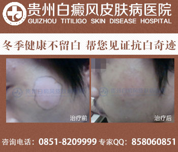按摩耳朵是否可以治疗白癜风的介绍