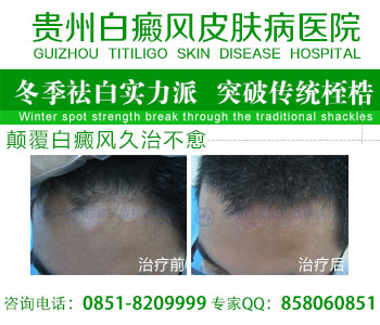 白癜风治疗方法有哪些
