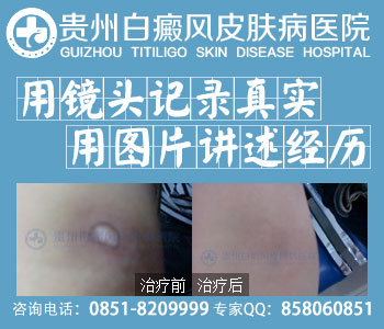白癜风用什么药合理用药保健康