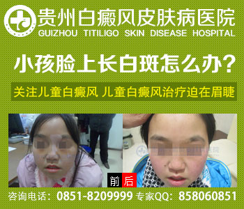 白癜风有没有特效药