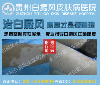 饮酒对白癜风危害