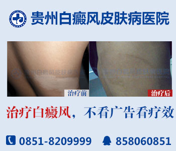 你是否了解得了白癜风传染吗