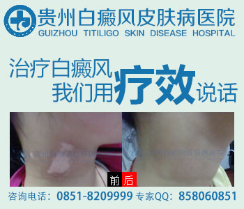 白癜风是什么原因引起的