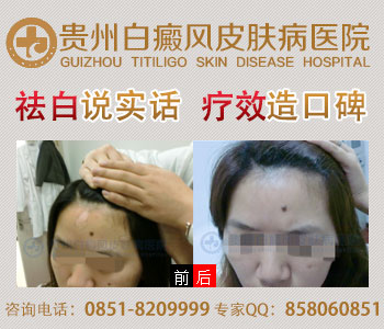 想游泳的白癜风患者要注意哪些