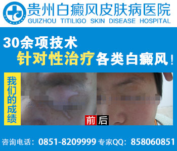 白癜风的治疗方案你了解吗