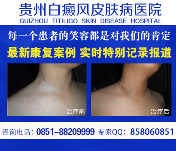 贵州哪家医院治疗白癜风好