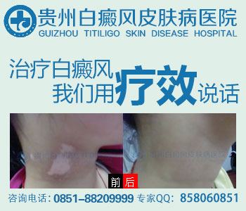 贵州白癜风哪家医院治得好