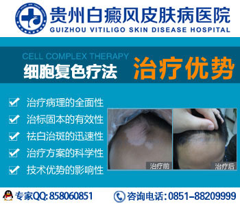 贵州有没有治疗白癜风的科医院