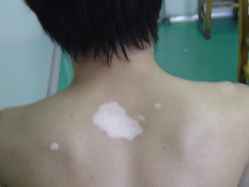 贵州白殿疯医院哪家最好